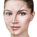پیور اسکین و تی‌تری اوریفلیم؛ کدام برای جوش‌های شما مناسب‌تر است؟